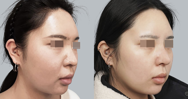 3D맞춤보형물+기증늑연골
