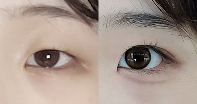 절개 눈성형
