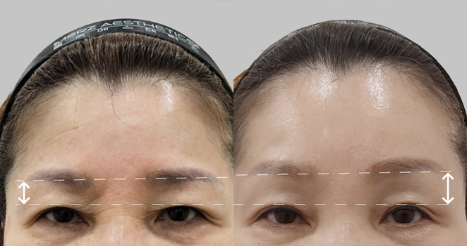 눈썹 이마거상술