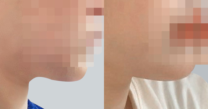 이중턱흡입+실리프팅