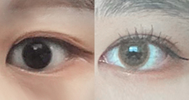 눈매교정+앞트임