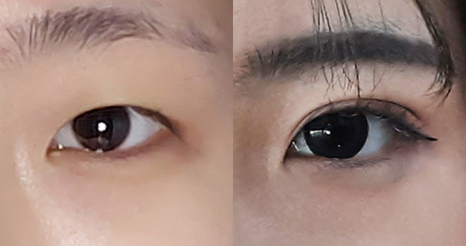 매몰 눈성형