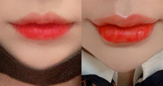 입술필러+입꼬리보톡스