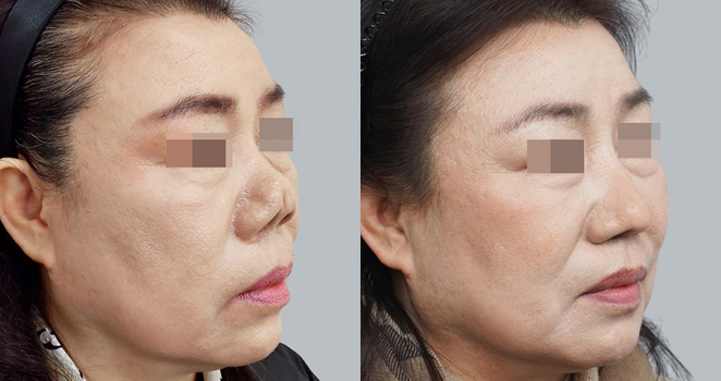 자가늑연골 재수술