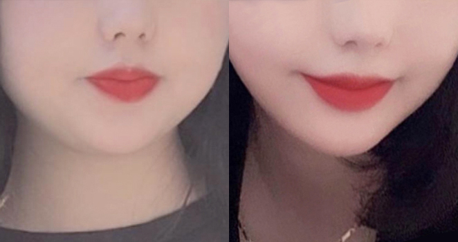 슈링크+턱보톡스