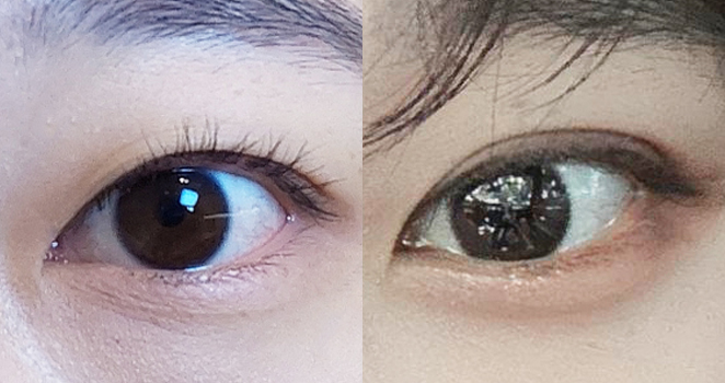 절개눈성형