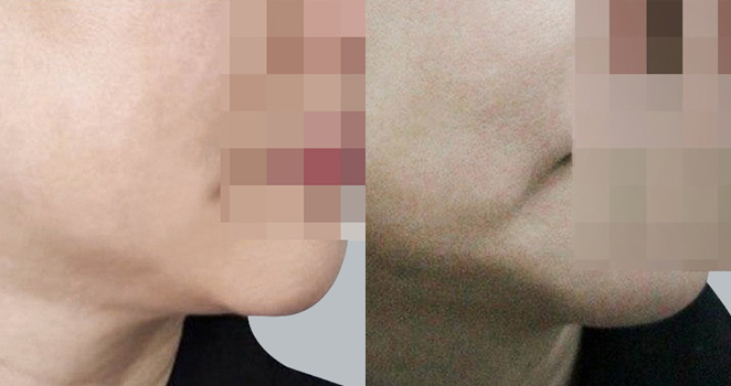 심부볼제거+실리프팅