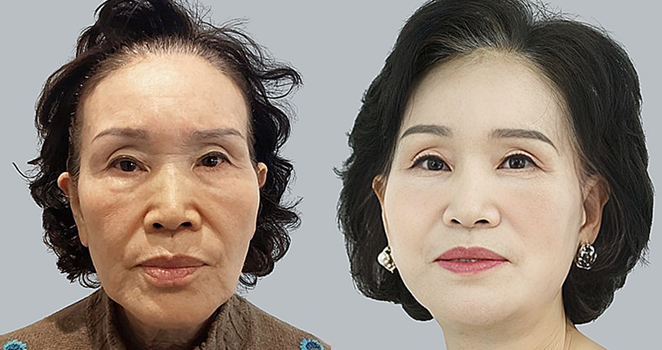 안면거상술