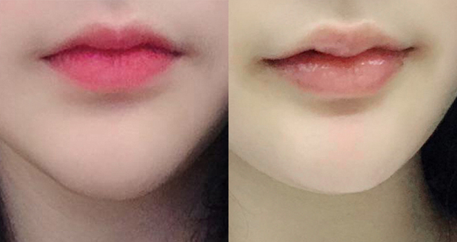 입술+입꼬리필러