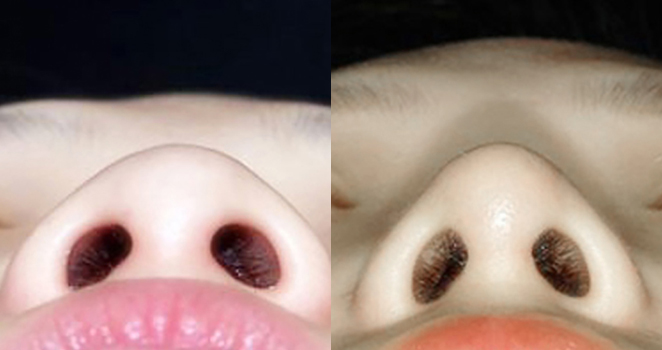 코끝 성형