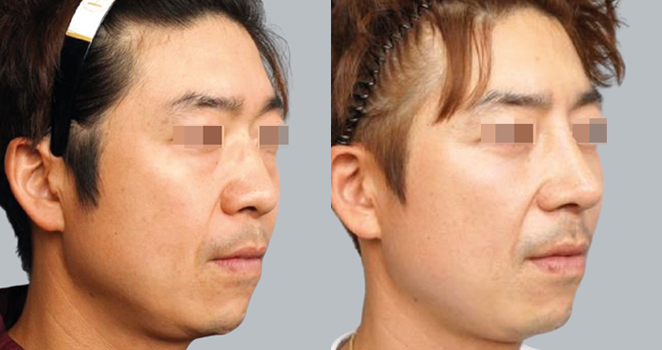 개방코성형+기증늑연골