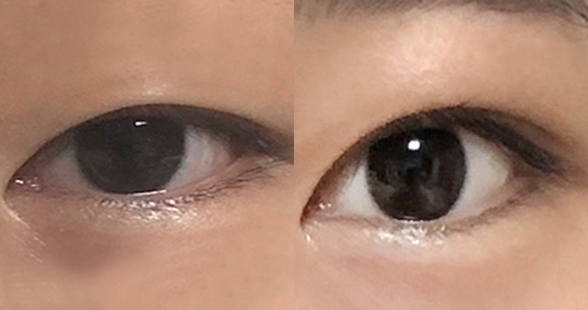 비절개 눈매교정