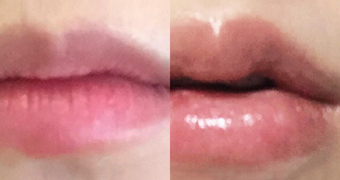 입술필러