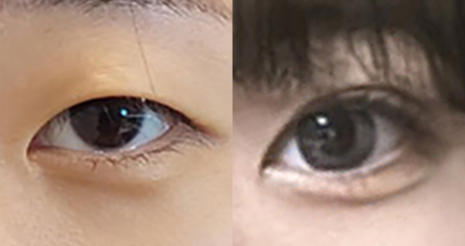 절개 눈성형+앞트임
