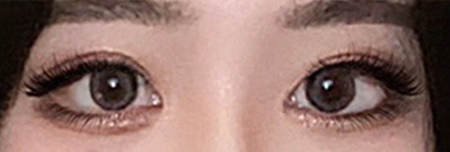 절개눈매교정+앞트임 6개월 후