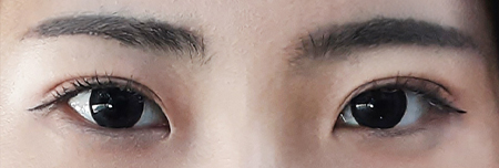 매몰 눈성형 3개월 후