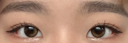비절개 눈매교정 6개월 후