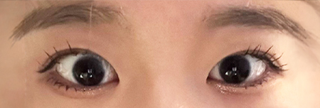 절개눈매교정 3개월 후