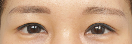 절개쌍꺼풀+눈매교정+뒤트임+밑트임 1개월 후