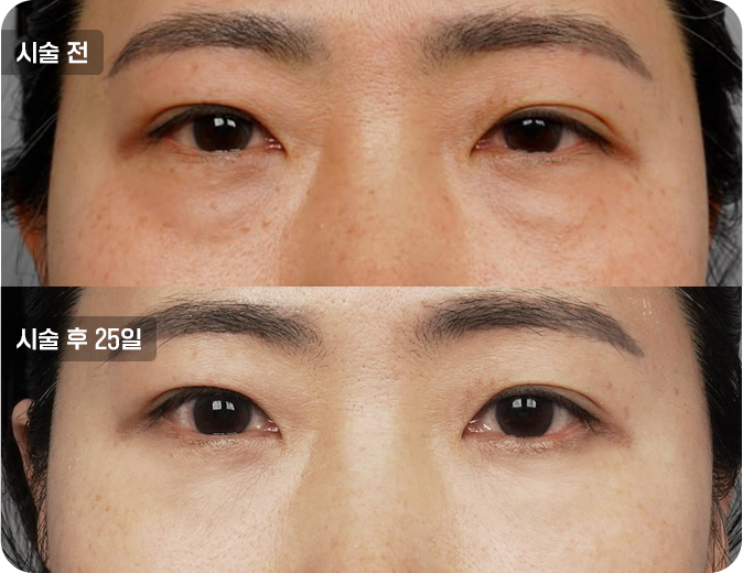 코성형수술전후사진