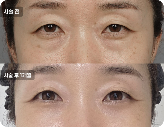 코성형수술전후사진