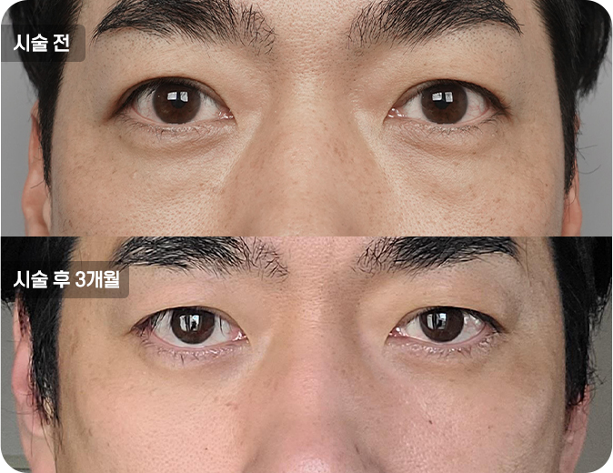 코성형수술전후사진