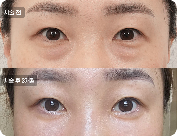 코성형수술전후사진