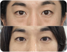 앙코르눈밑지수술전후사진