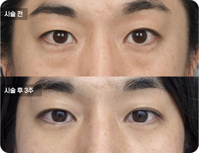 코성형수술전후사진