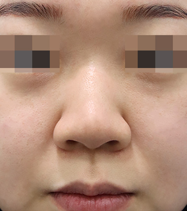 수술전