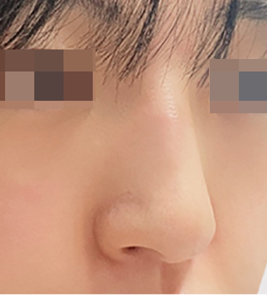 수술전