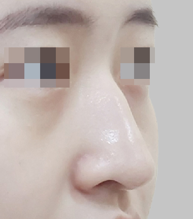수술전