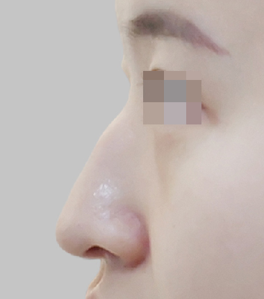 수술전