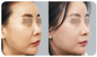 코성형수술전후사진
