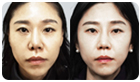 코성형수술전후사진