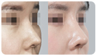 코성형수술전후사진