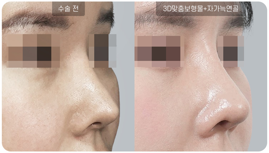 하안검수술전후