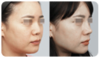 코성형수술전후사진