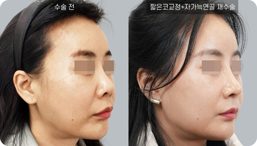코성형수술전후사진
