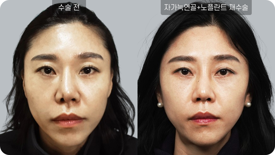 코성형수술전후사진