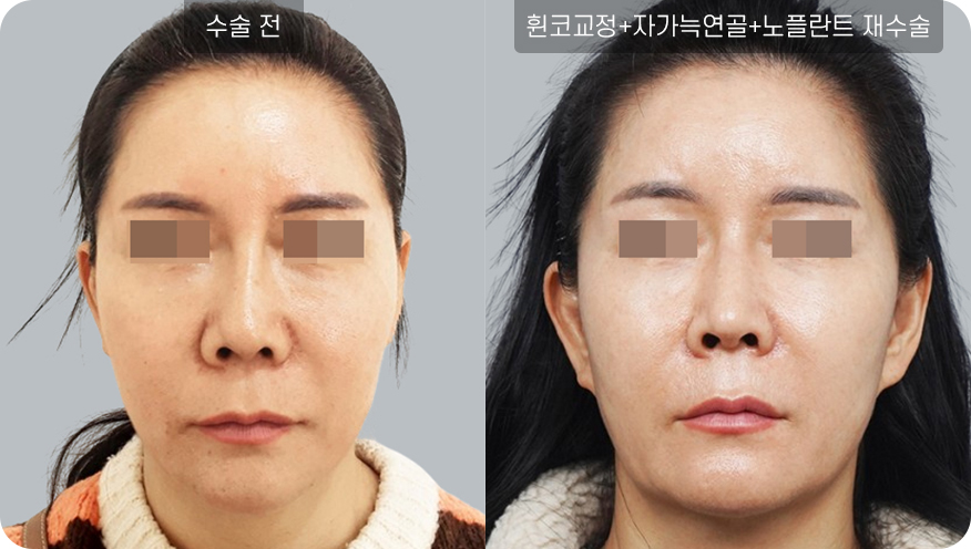 코성형수술전후사진
