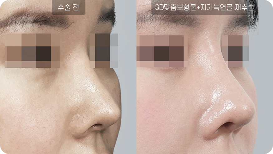 코성형수술전후사진