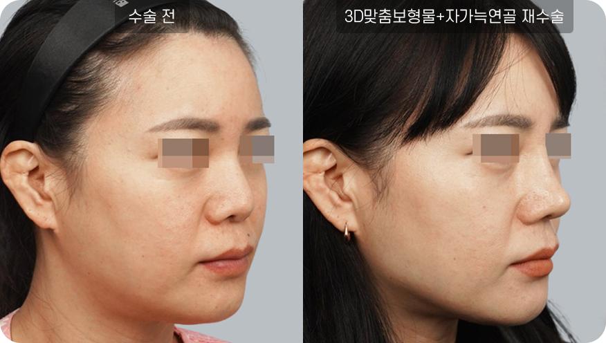 코성형수술전후사진
