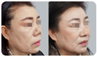 코성형수술전후사진