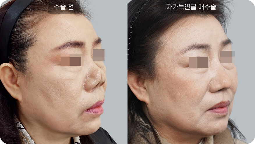 코성형수술전후사진