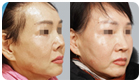 코성형수술전후사진