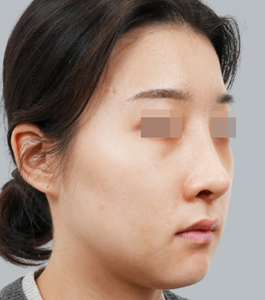 개방코성형+3D맞춤보형물+자가늑연골 2주 후