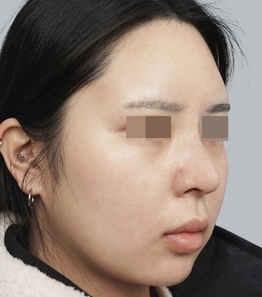 3D맞춤보형물+기증늑연골 한달 후