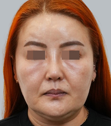 3D맞춤보형물+기증늑연골 한달 후