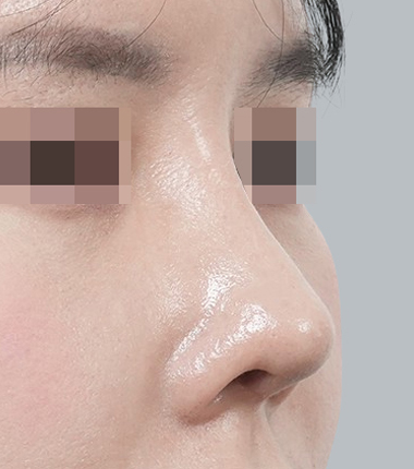 3D맞춤보형물+자가늑연골 한달 후